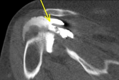 Figure 2 for case Supraspinatus and biceps tendon tears ( RID1953 )( RID1944 )